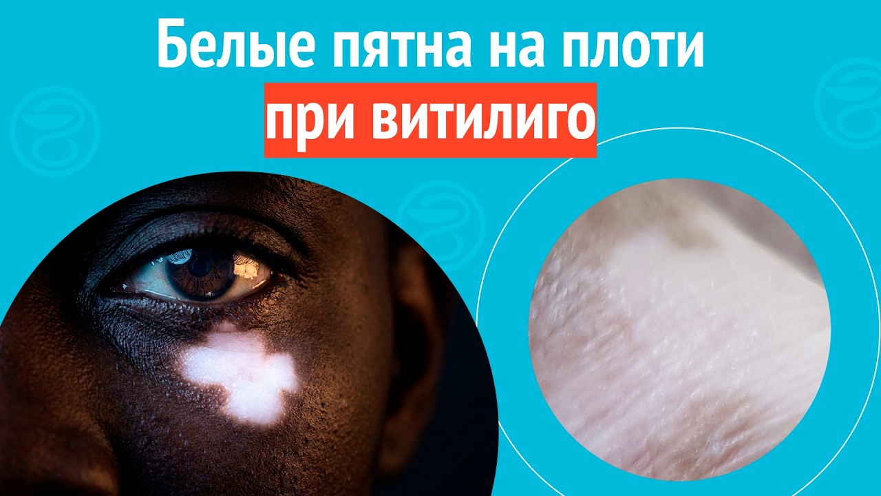 🙁 Белые пятна на плоти при витилиго. Клинический случай № 1710