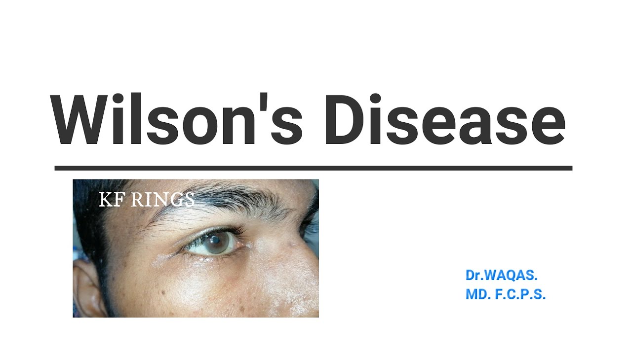 WILSON DISEASE.(Examination Skills)