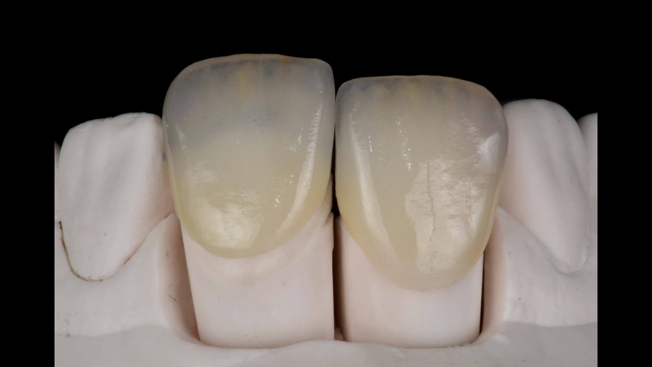 Céramiques stratifiées en technique 'réfractaire'(emax céram)