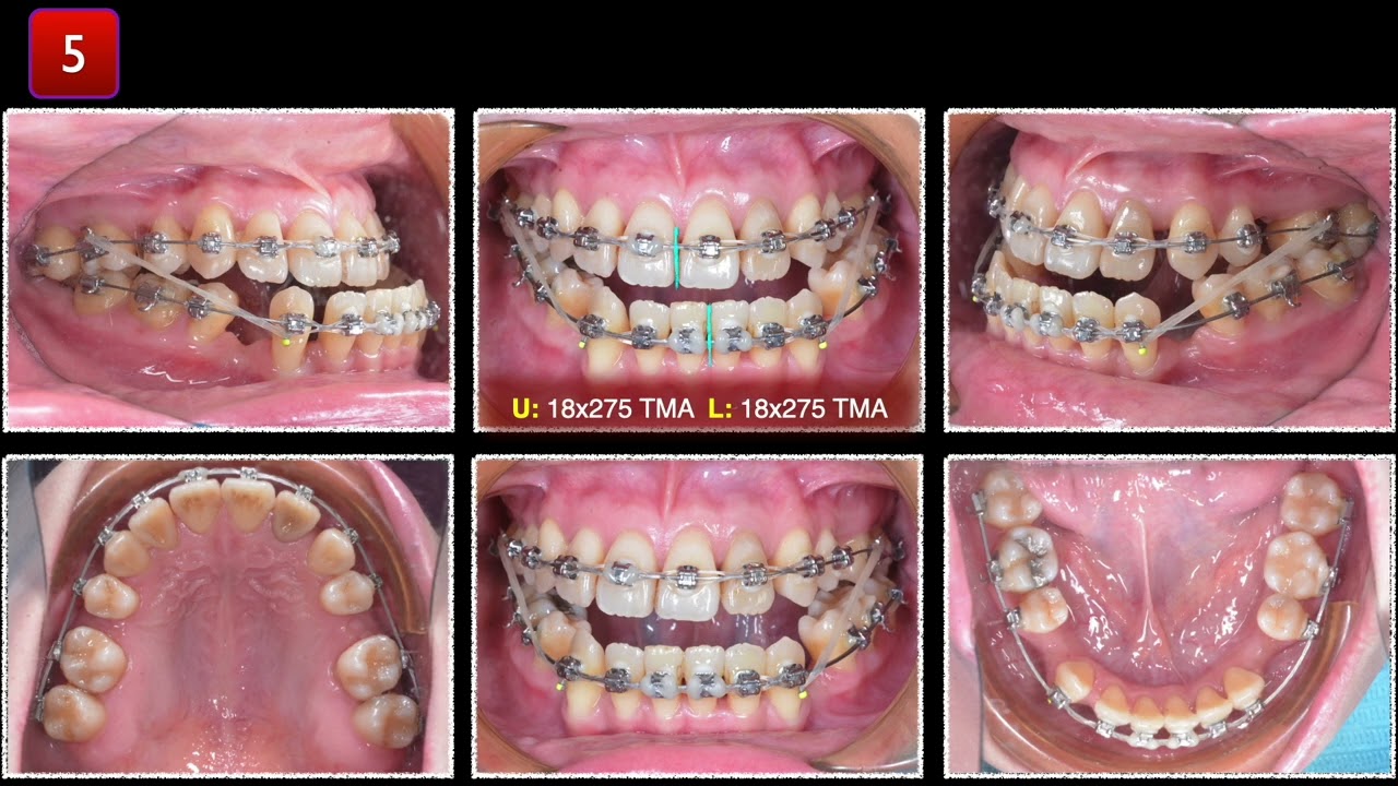 Асимметрия III класса ｜【Chris Chang Ortho】CC859
