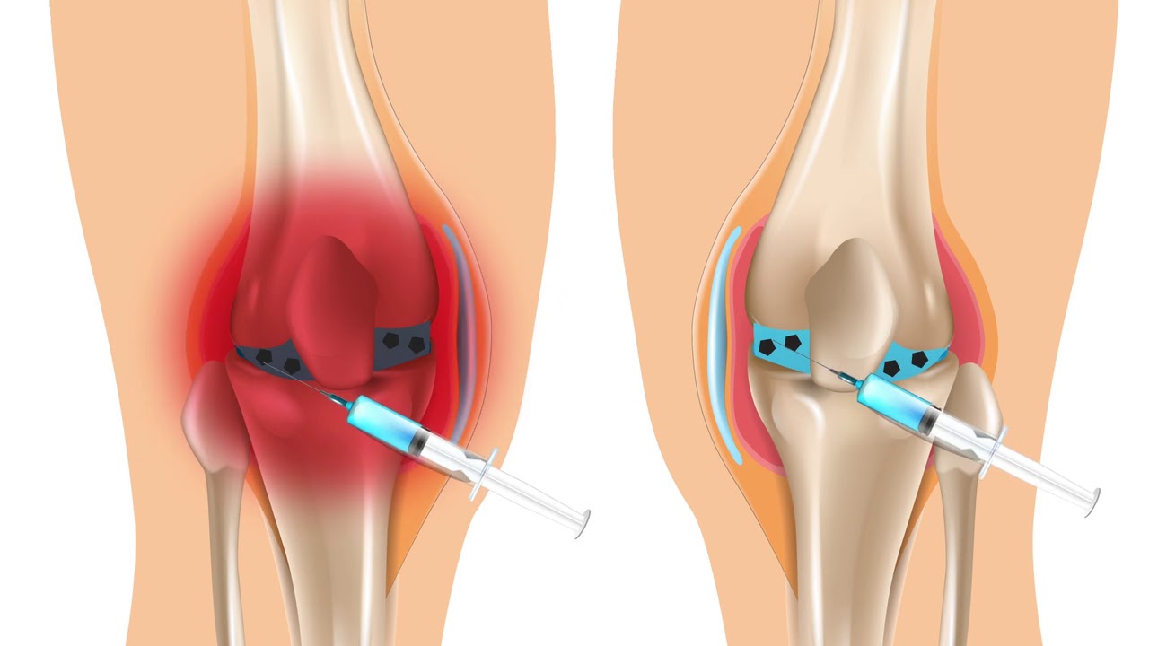 Synovial fluid biomarkers give a glimpse at the intra articular environment after a meniscal injury