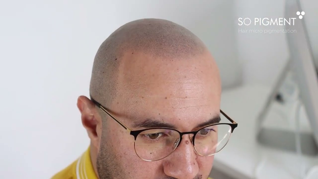 Scalp Micropigmentation capillaire, Montréal et Paris. Introduction