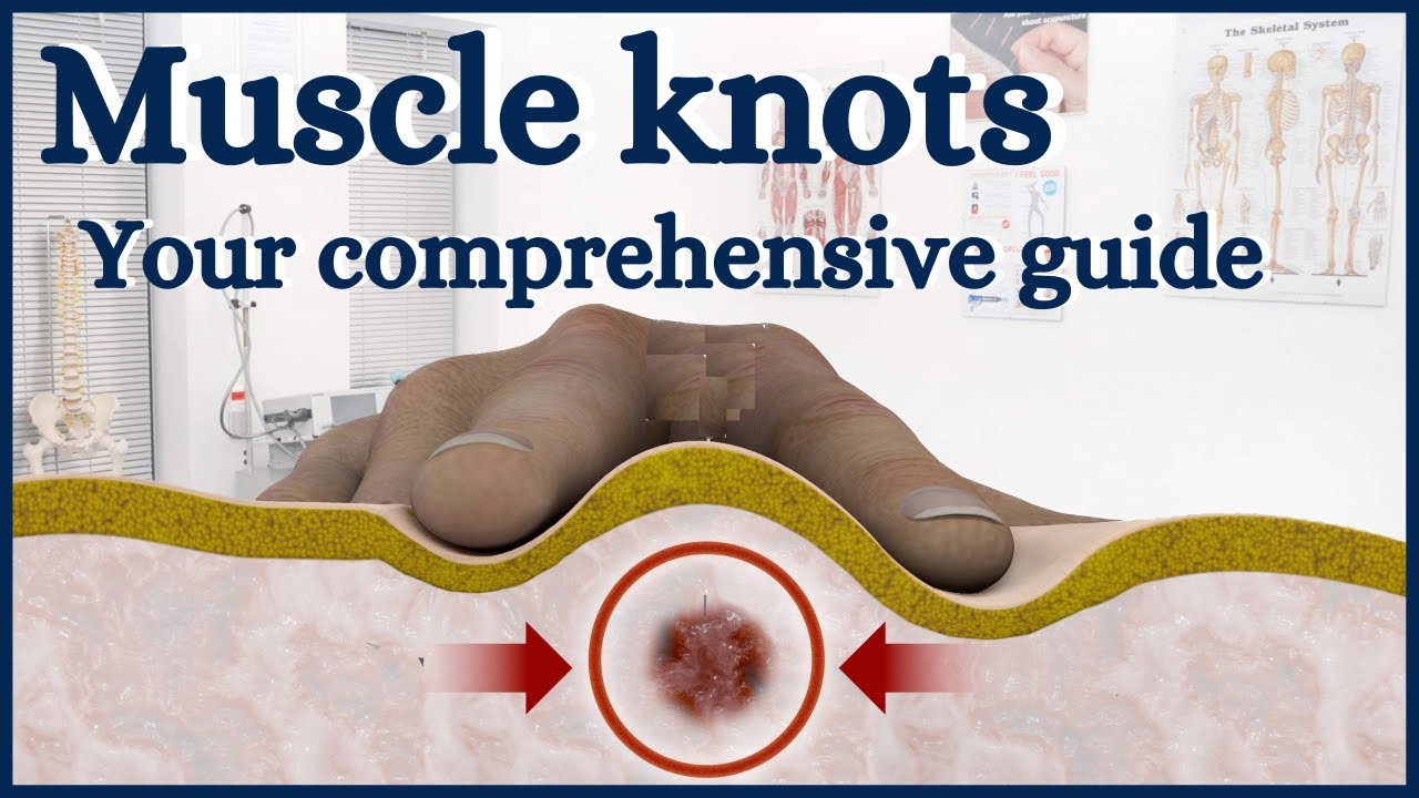 Muscle knots: your comprehensive guide