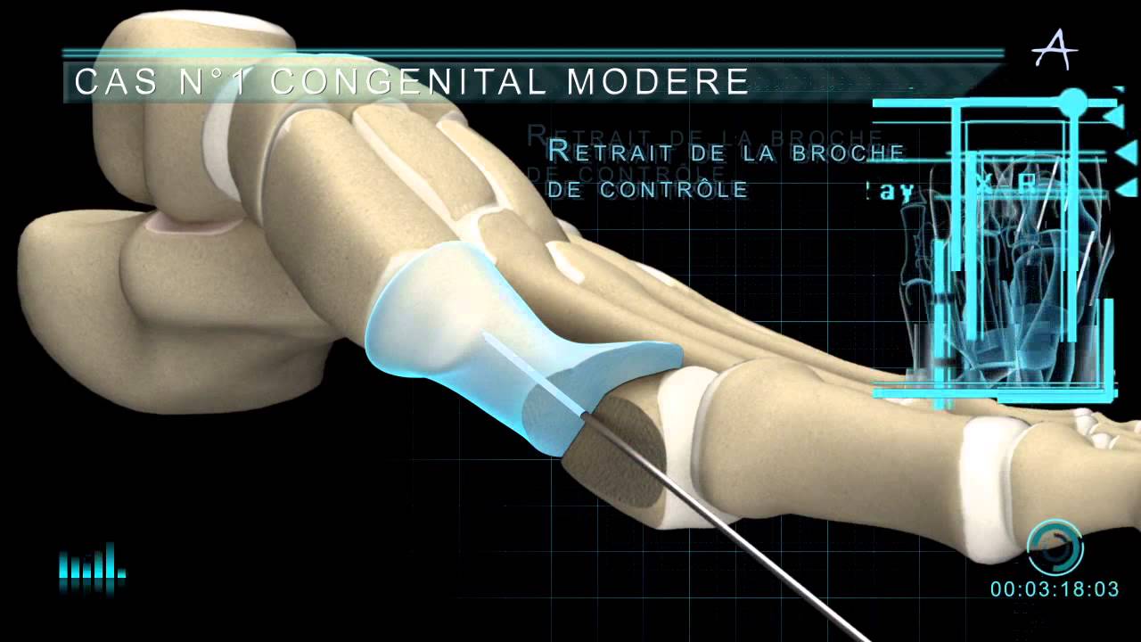 Technique opératoire Hallux valgus