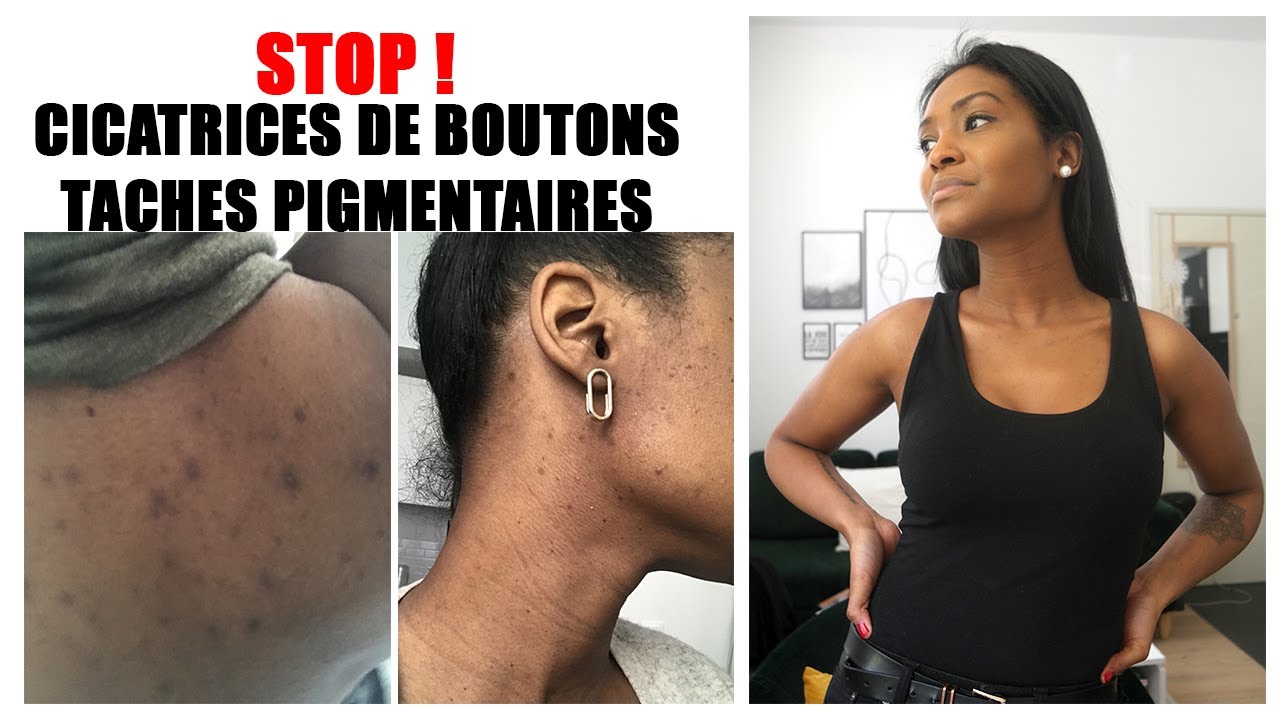 ROUTINE contre les cicatrices de boutons & taches pigmentaires I Manuela Miro
