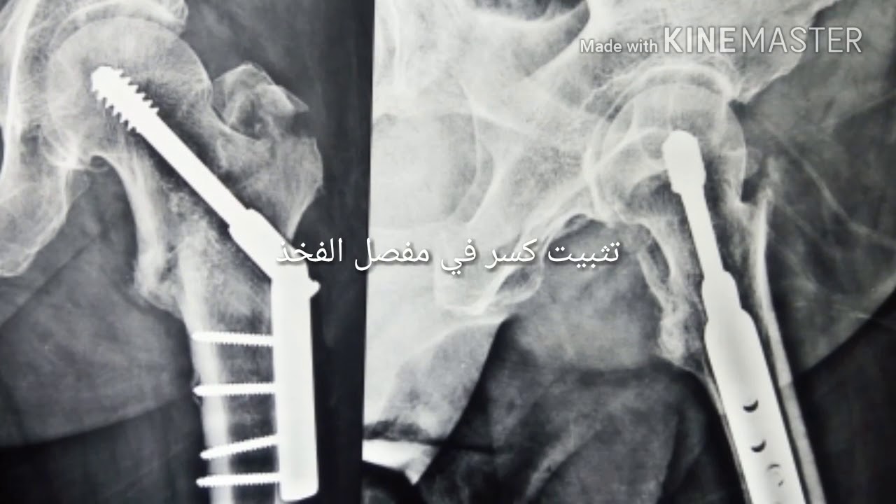 تثبيت كسر في اعلي الفخذ بعد شهر من العمليةdhs for Trochanteric fracture 1 month f postoperative