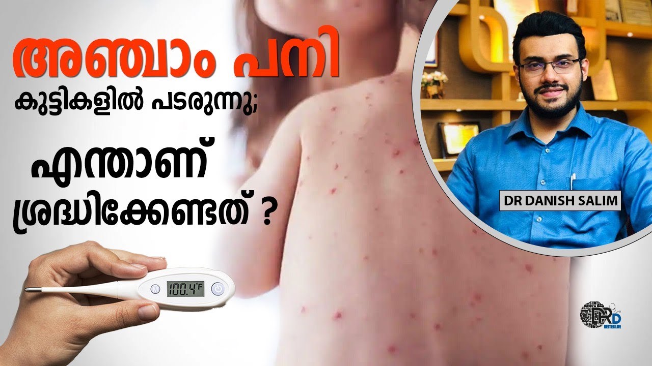 1167:👶കുട്ടികളിൽ അഞ്ചാം പനി. എന്താണ് ചെയ്യേണ്ടത്? Measles is spreading in children,What to be done?