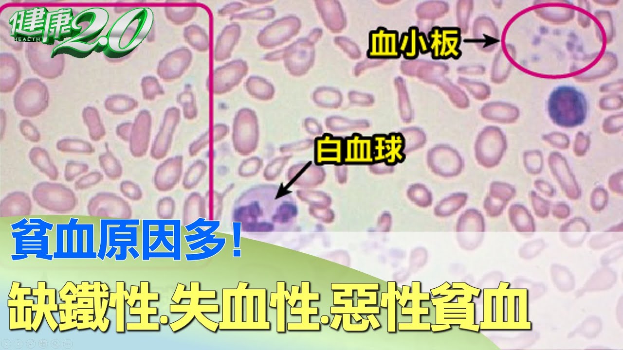 貧血原因多！缺鐵性貧血.失血性貧血.惡性貧血 健康2.0
