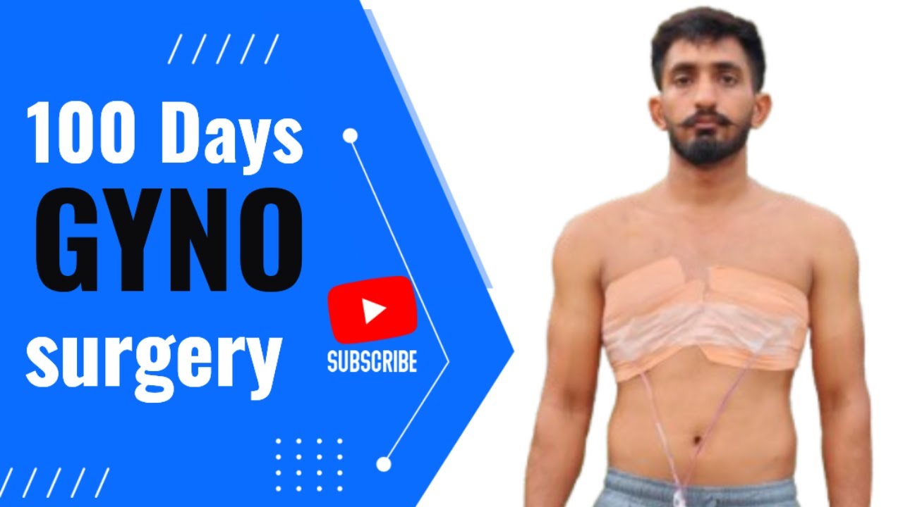 100 Days After Gynecomastia Surgery | Physique Update & Seroma Complications Explained