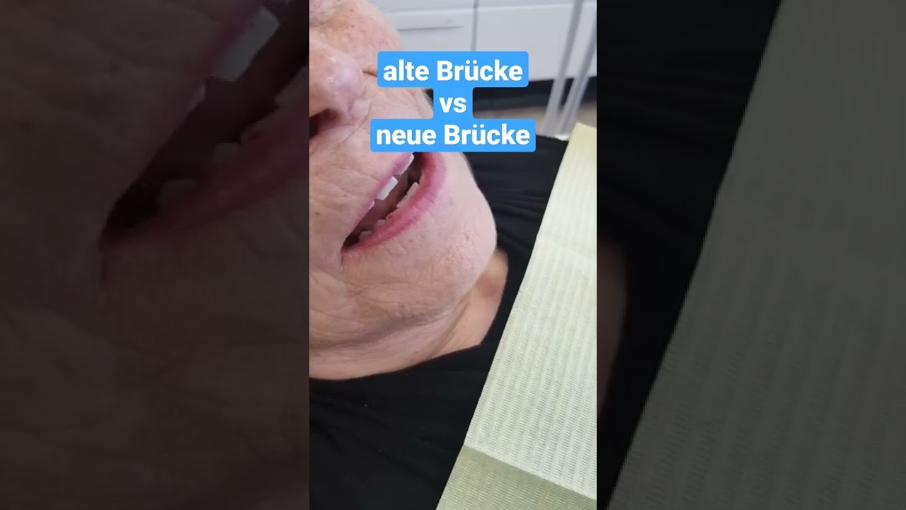 Alte Br&uuml;cke vs neue Br&uuml;cke - Gold Vollkeramik Zirkon #zahnarzt #zahnarztlive #zahnersatz