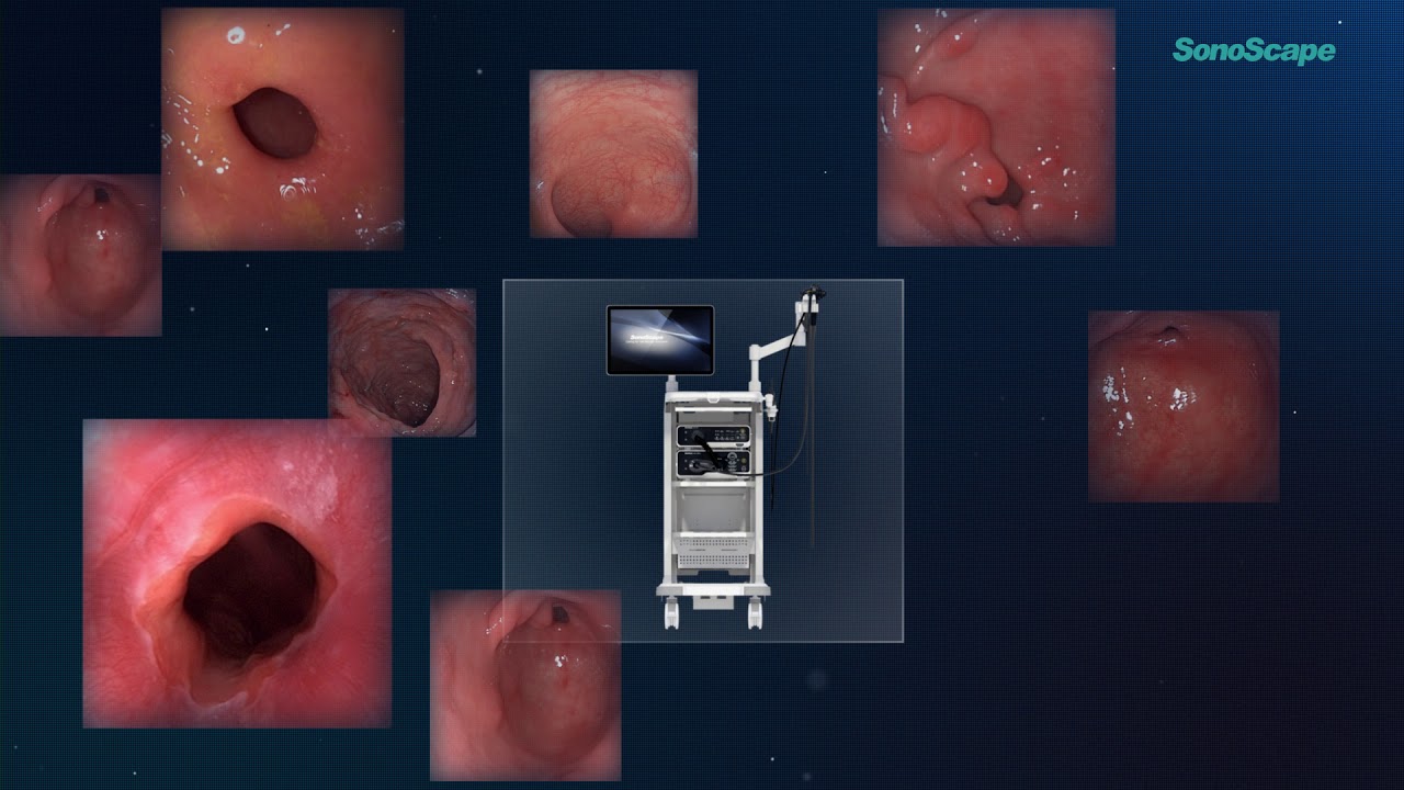 ENDOMED - SYSTEM ENDOSKOPOWY SonoScape HD 500