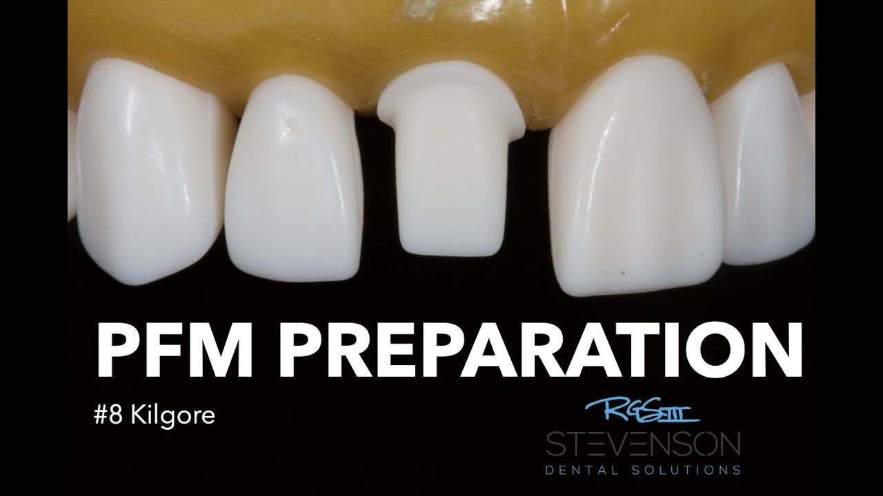 Подготовка к процедуре PFM для №8 в Килгоре | Stevenson Dental Solutions