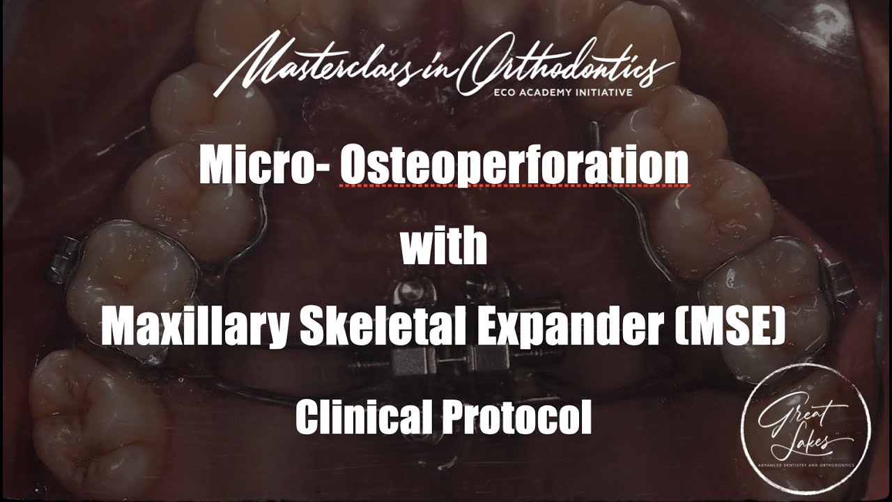 Micro-Osteoperforation with Maxillary Skeletal Expander | MSE | Jaw Expansion | Clinical Protocol