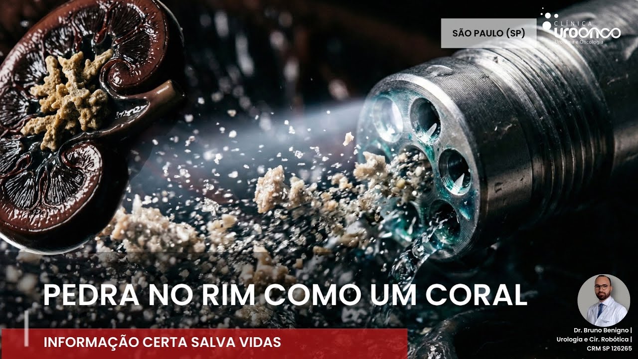 Percutânea ou Laser? A Estratégia Avançada para eliminar Cálculos em Coral