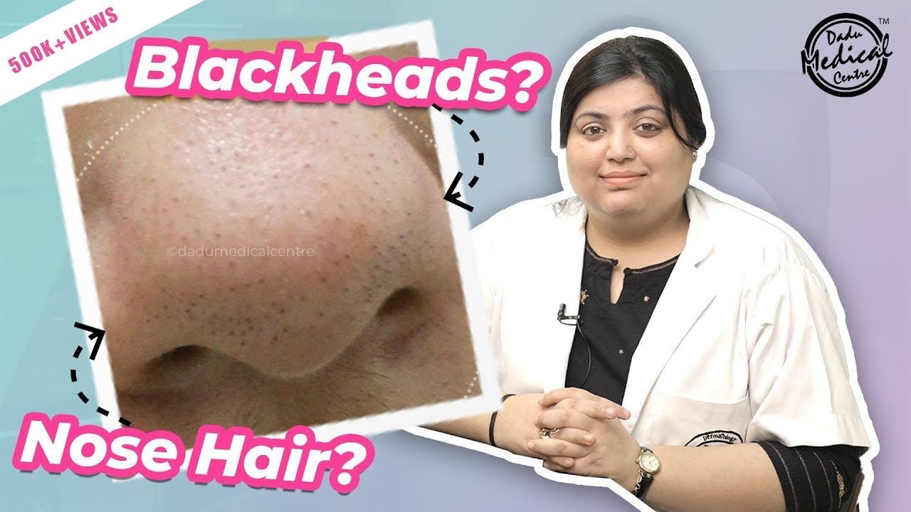 Nose Hair or Blackheads | How to Remove Nose Hair? | Trichostasis Spinulosa