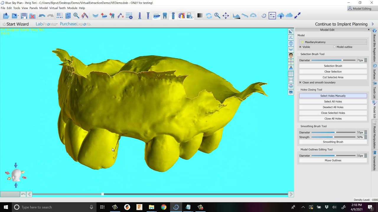 BlueSkyPlan Model: Virtual Tooth Extraction