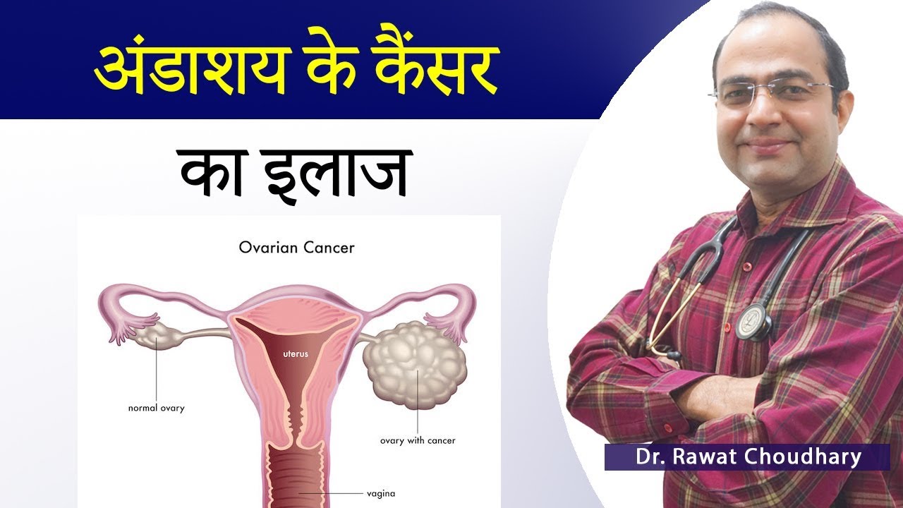 Ovarian Cancer Treatment | अंडाशय के कैंसर का इलाज | Best Treatment of Cancer