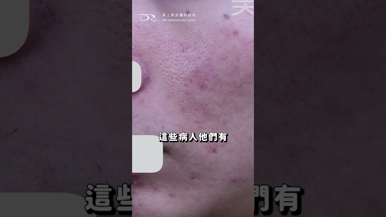 痘痘肌怎麼變成酒糟肌？背後的原因你知道嗎？ #痘痘 #青春痘 #蠕形蟎蟲 #酒糟肌 #痘疤 #保濕 #肌膚屏障功能 #敏感肌