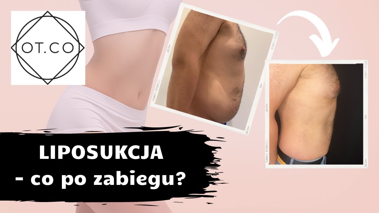 Liposukcja Vaser Lipo - Co po Zabiegu? OT.CO Clinic