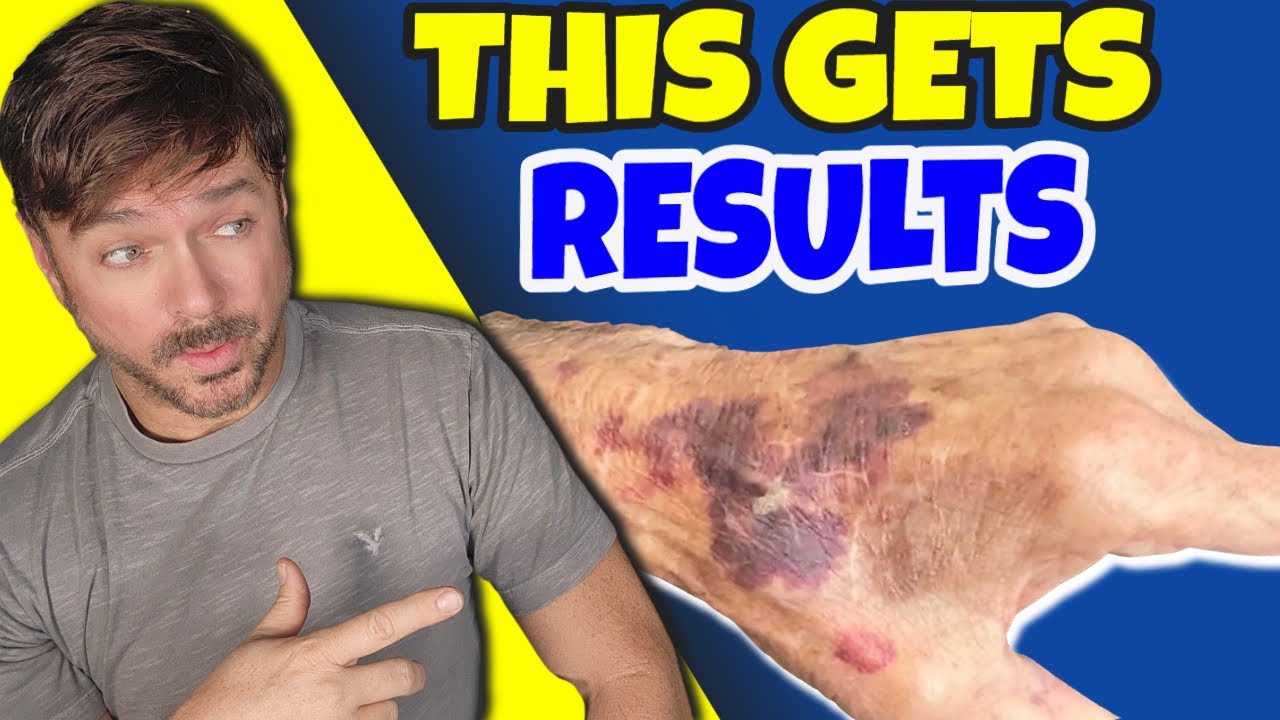 Miraculous Oil STOPS Purple Bruising on Aging Skin | Chris Gibson