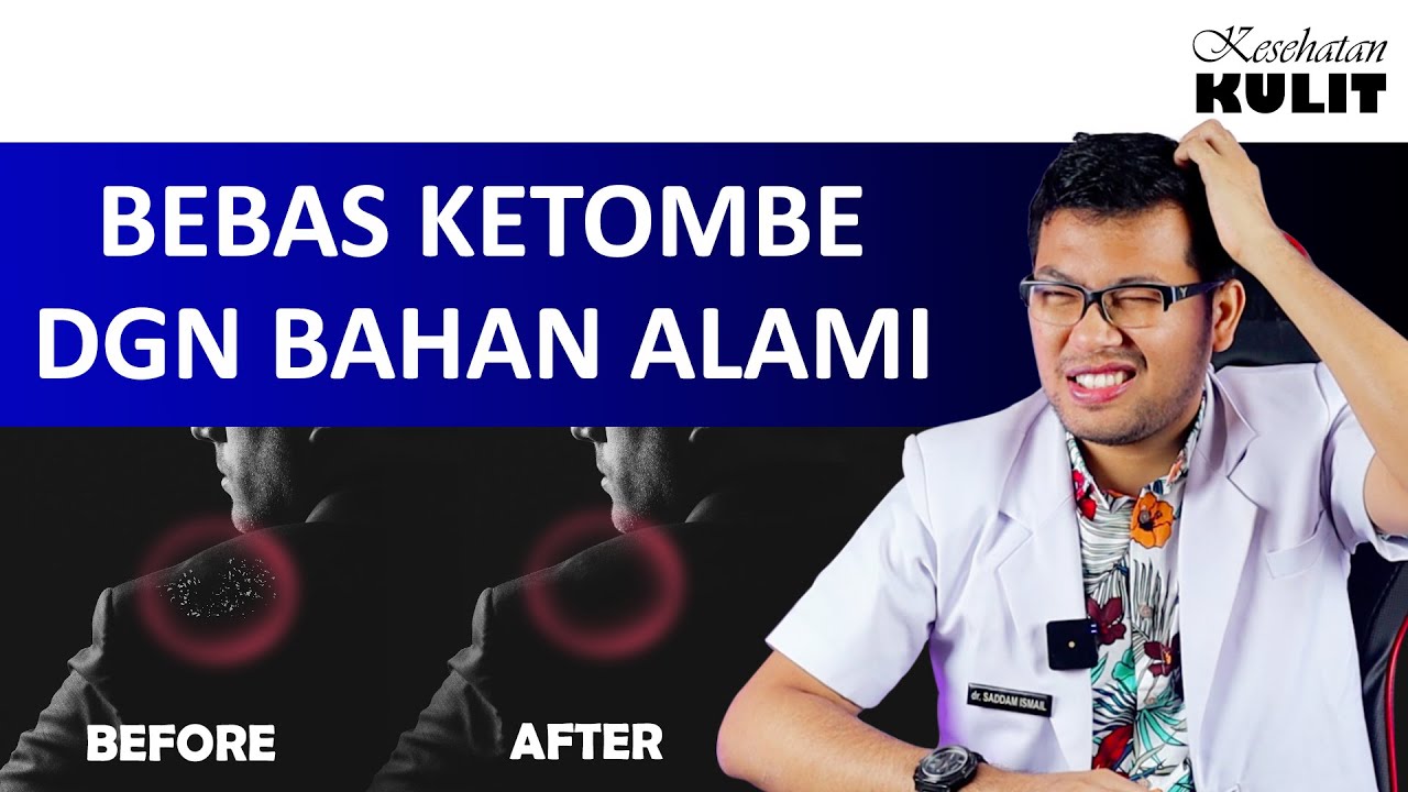 CARA MENGHILANGKAN KETOMBE SECARA ALAMI - DOKTER SADDAM ISMAIL