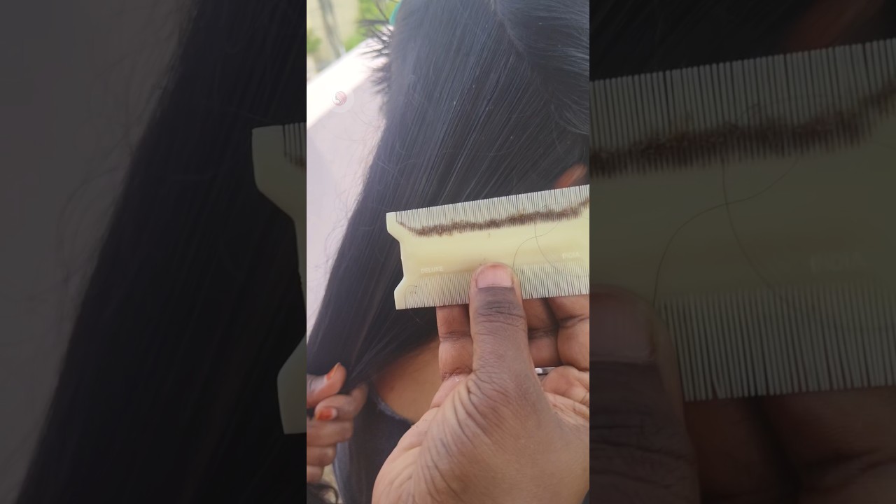 Head lice And Nits Treatment in 2Hrs 🫣#youtubeshorts #shortsfeed #shorts #hair #headlice #lice #yt