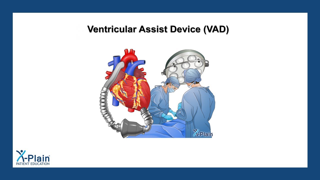Ventricular Assist Device (VAD)