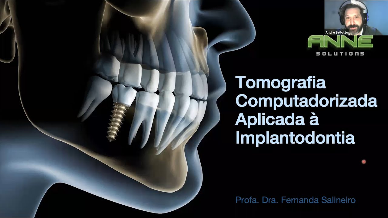 Webinar Anne Solutions: Tomografia aplicada à implantodontia e estudo de caso com o Imaging Studio
