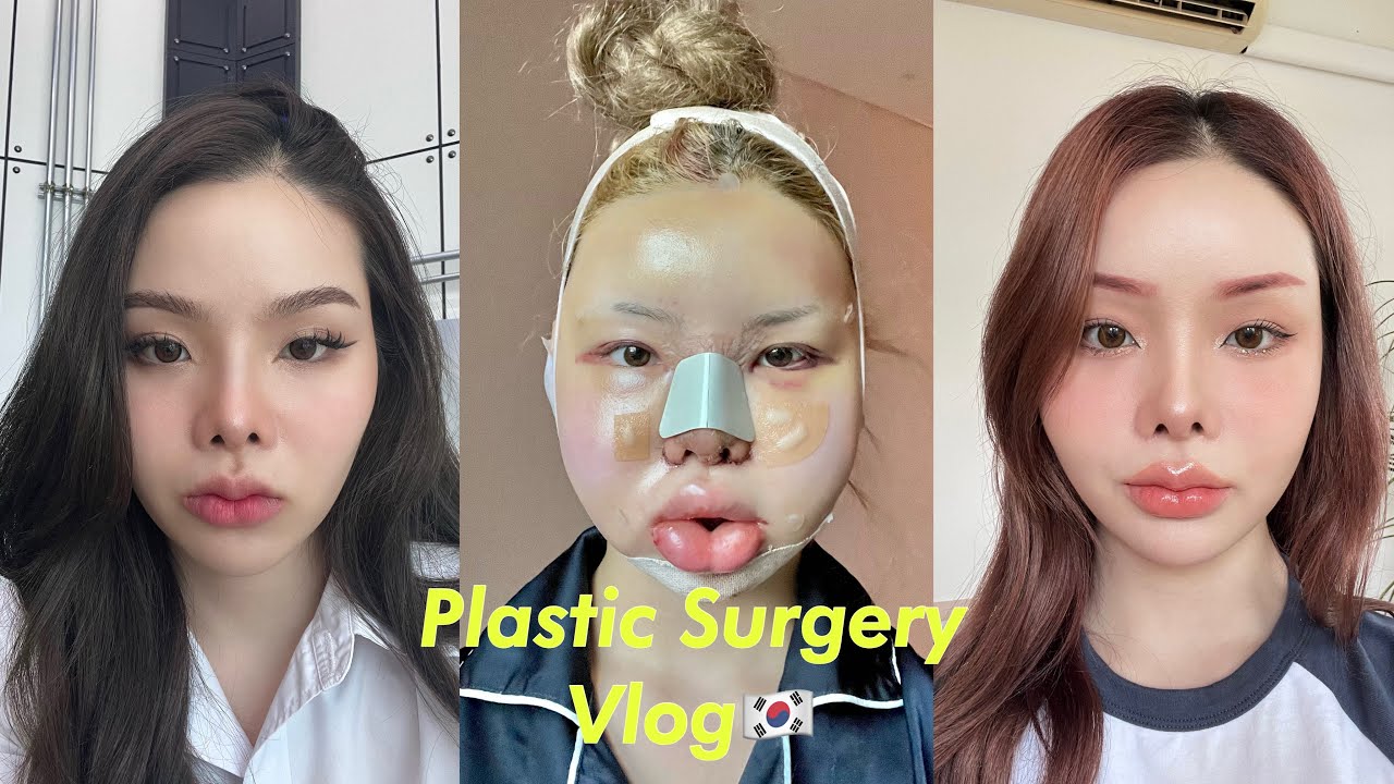 Korea Vlog🇰🇷 ep.2 พาชม 14 วันหลังพักฟื้นศัลยกรรม ทำอะไรได้บ้าง| Jammamyy