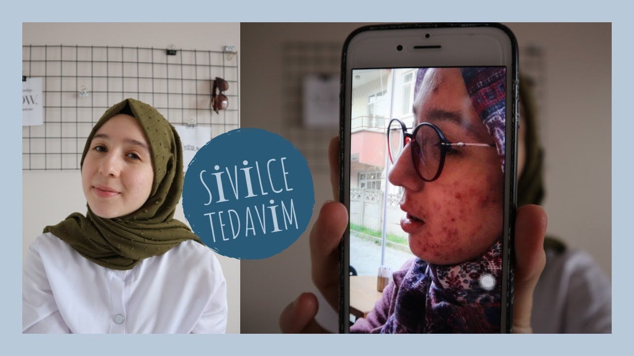ÇOK ZORLU BİR SÜREÇTİ | Sivilce Tedavim, Zoretanin Kullanımı