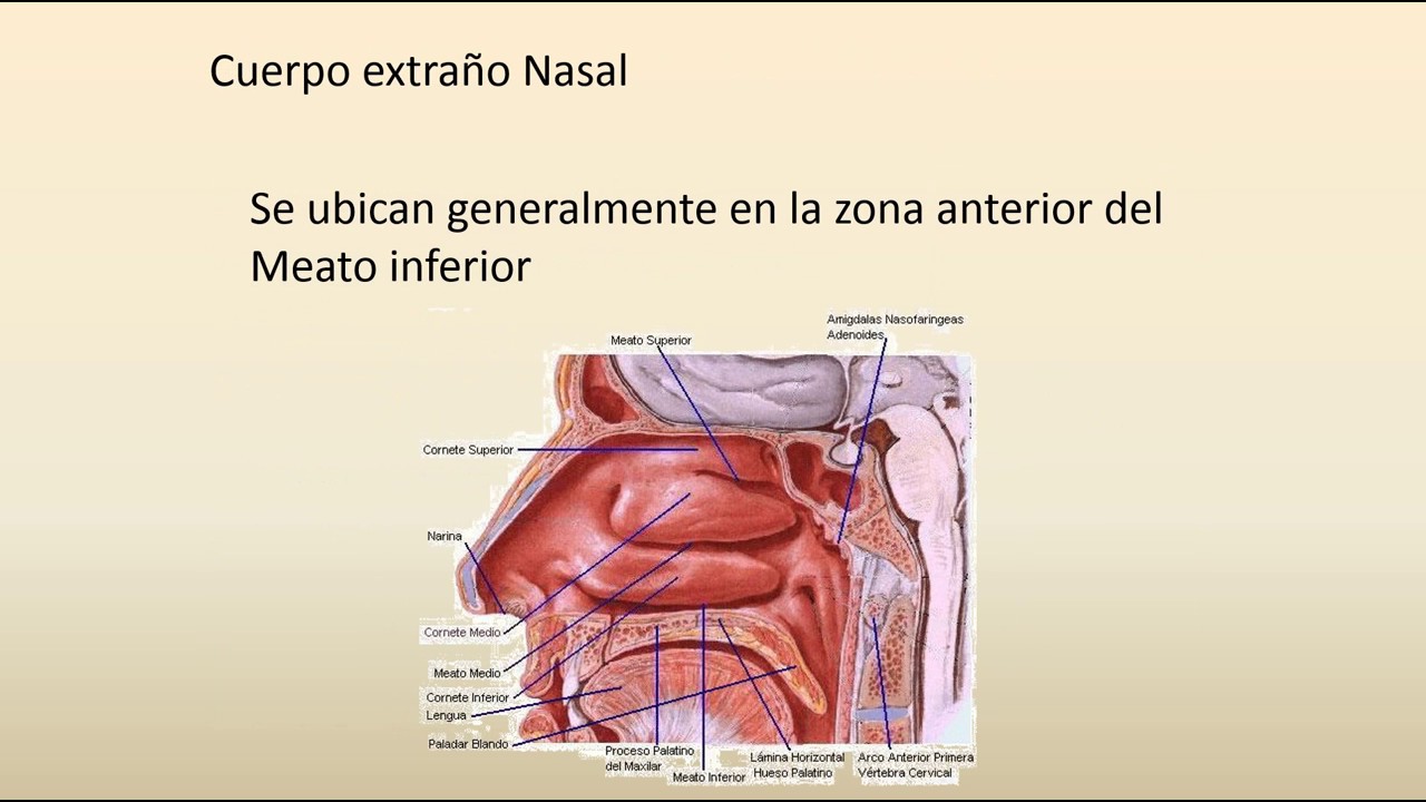 Cuerpo extraño nasal #FOAMed #MUE #ChileEM