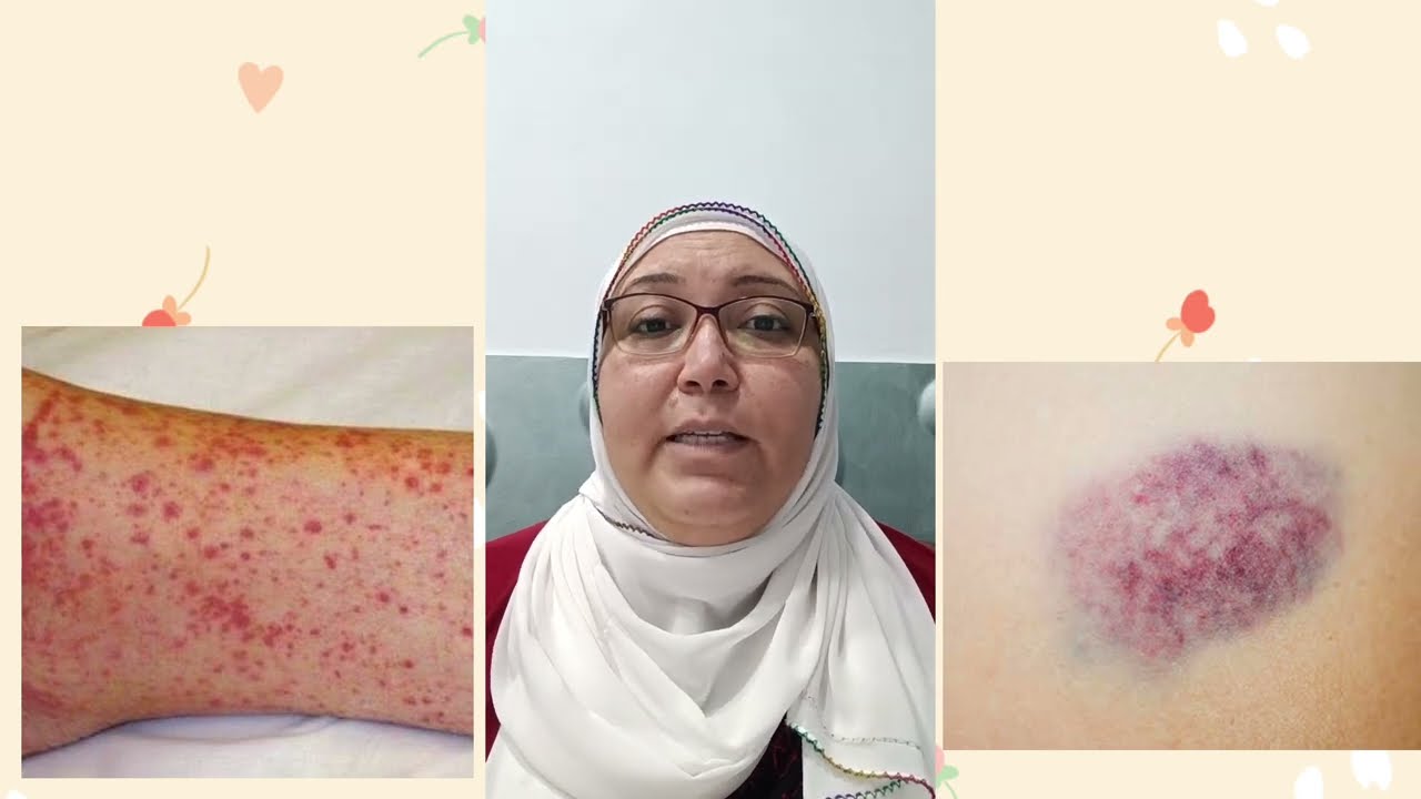ايه هو نقص الصفائح الدموية المناعي ...معلومات تهمك مع د ولاء السلكاوي استاذ امراض الدم
