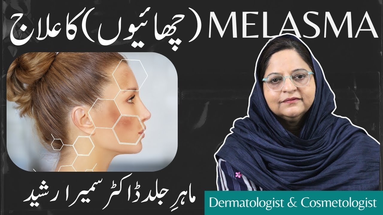 What is Melasma? چھایاں کیا ہوتی ہیں؟ | How can it ruin our skin? Cause and Treatments