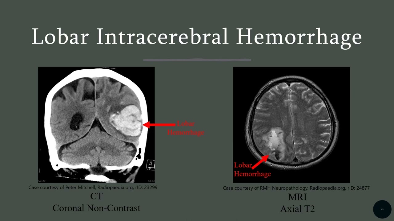 Chloe Vingee Lobar Cerebral Hemorrhage