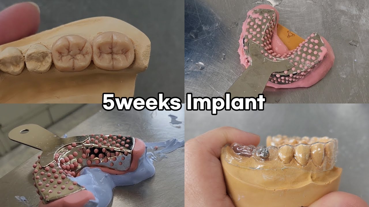 [Implant|임플란트] 진단용 스텐트 | dignostic(radiographic) stent