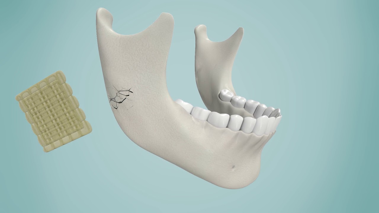 Resorbable Ceramic Biocomposites for Orthpaedic and Maxillofacial Applications
