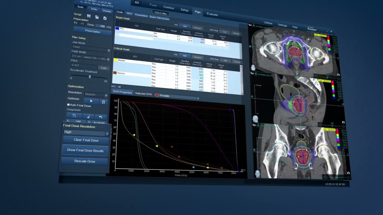 VOLO&trade; Ultra : A New Way of Planning and Optimizing for TomoTherapy and Radixact Systems