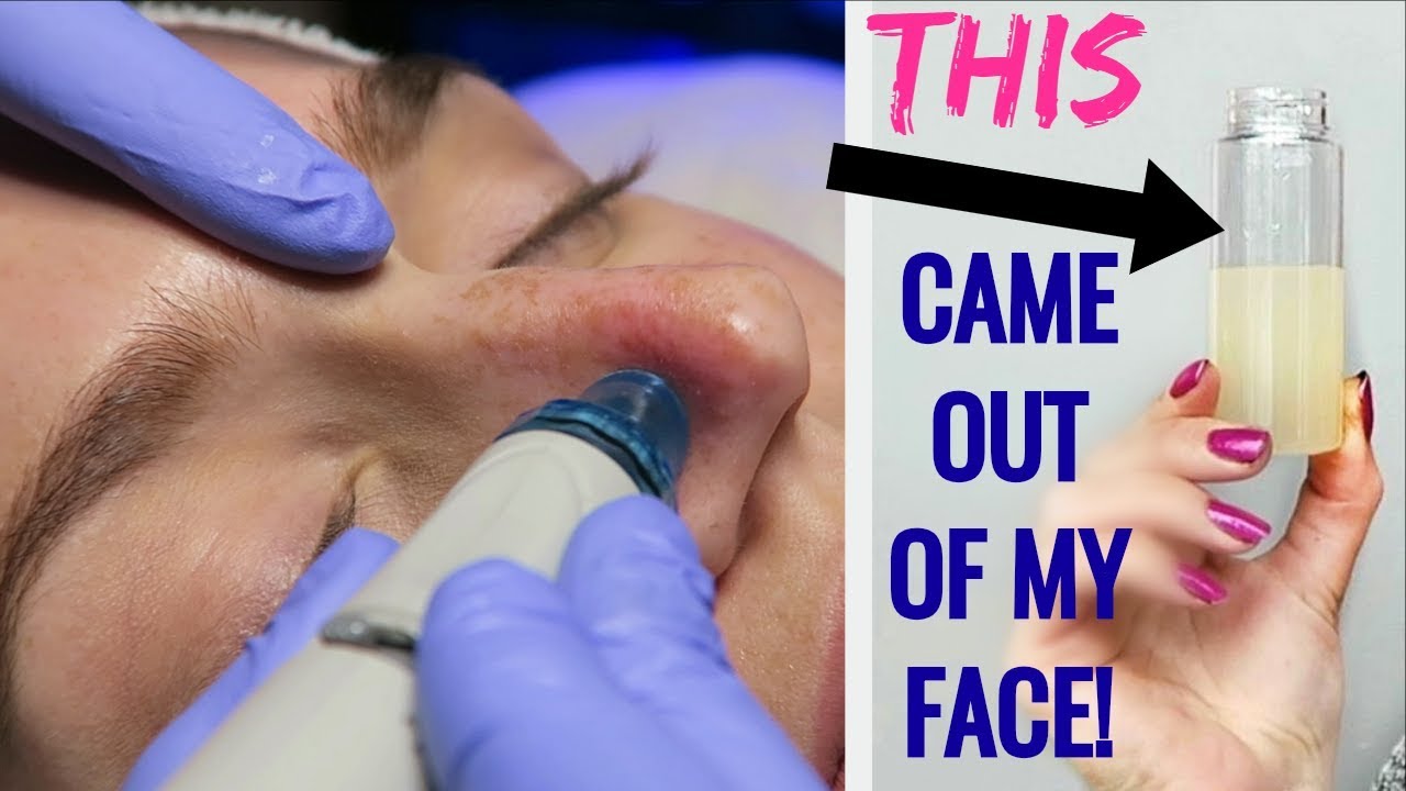 Getting My Pores SUCKED CLEAN! My First Hydra Facial Experience