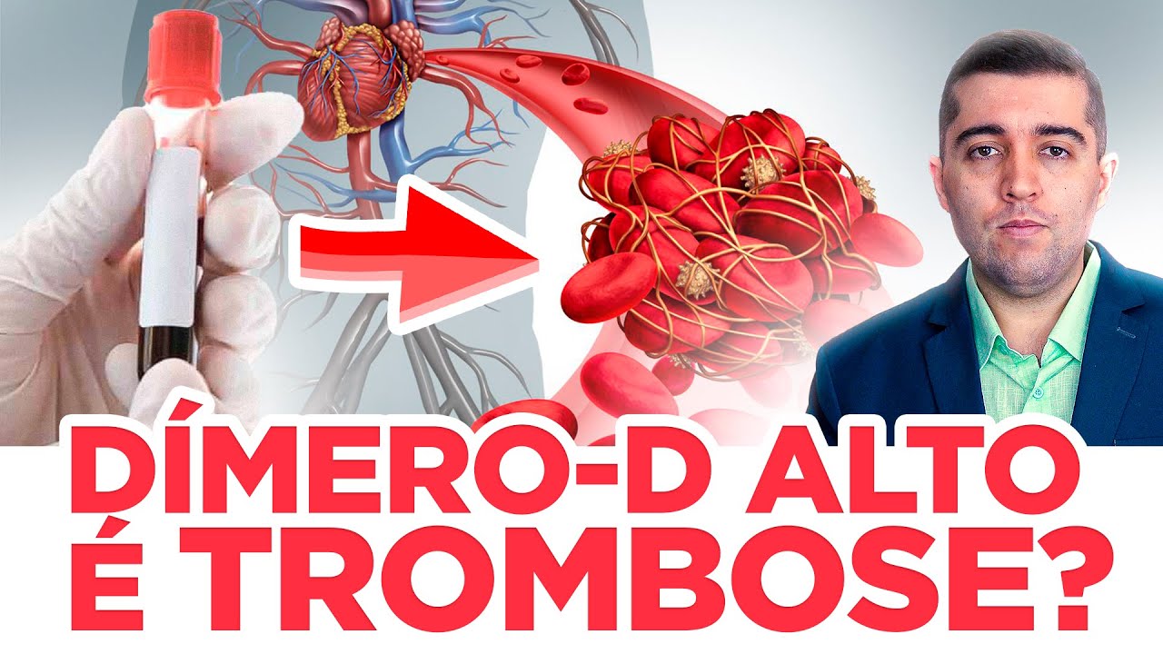 Dímero alto, o que fazer? Tenho má circulação e trombose, precisa de anticoagulante, como abaixar?
