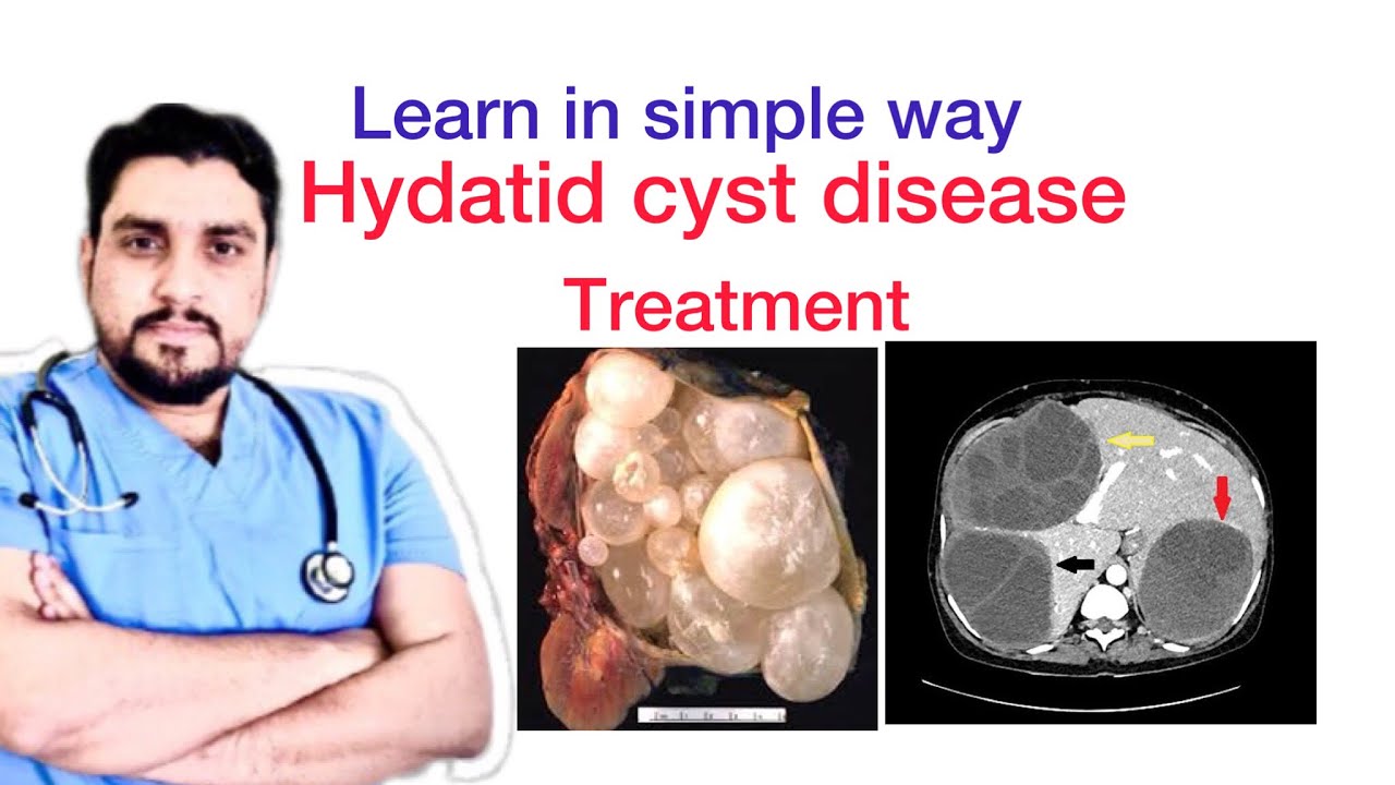 Hydatid cyst disease of liver/Treatment