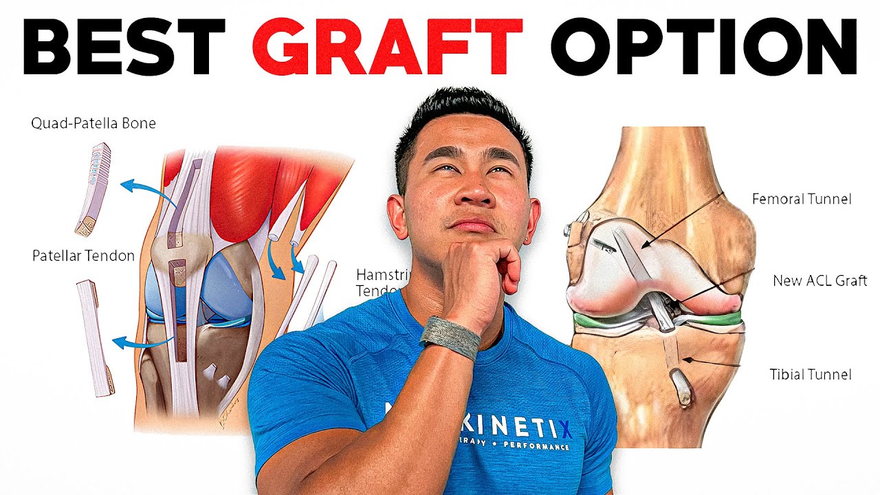 An Athlete's COMPLETE Guide to ACL Grafts