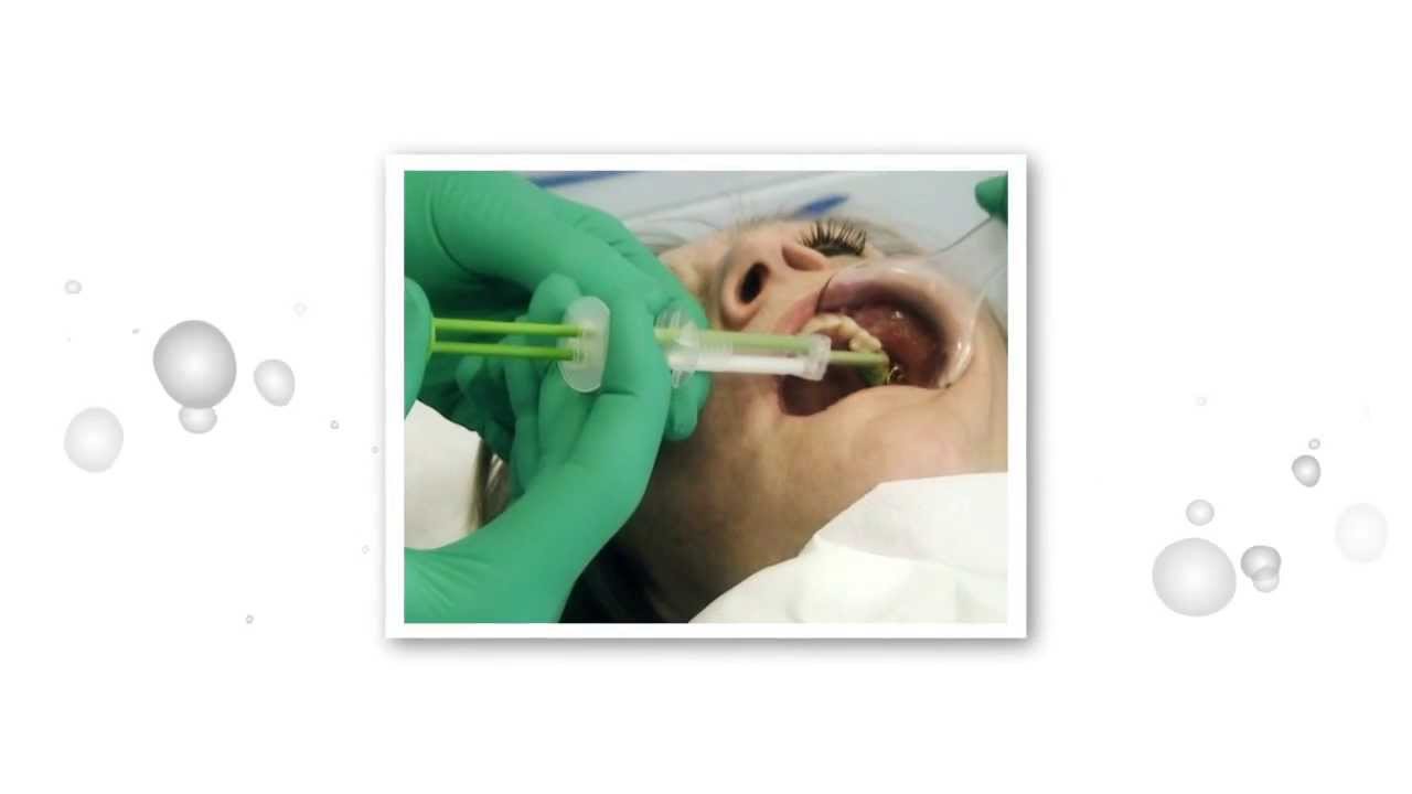 3M ESPE Intra-Oral Syringe - MDEA 2013 Finalist