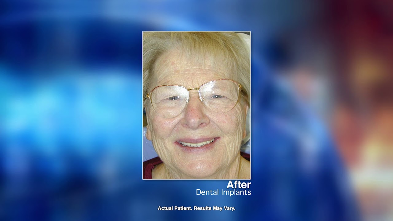 Replacing Missing Teeth with Dental Implants with Waterloo, Ontario dentist Dr. George Arvanitis