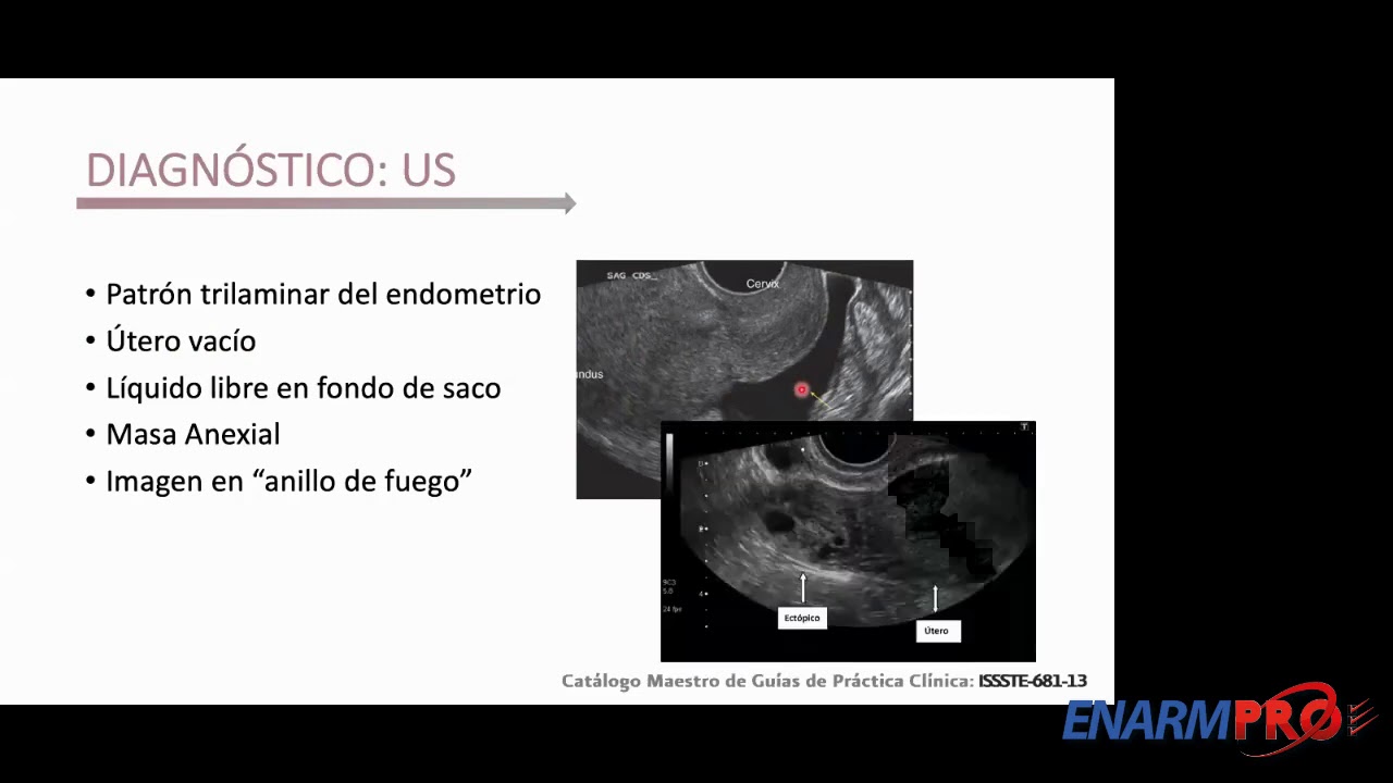 EMBARAZO ECTOPICO - ENARMPRO 2020