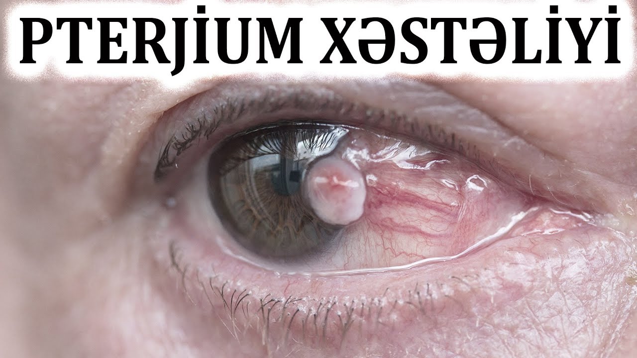 Göz əti nədir - NİYƏ yaranır?