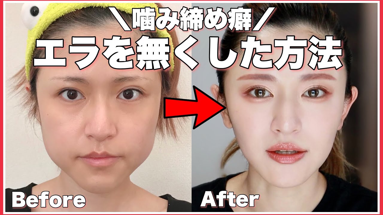 【エラ】と噛みしめ癖なくした方法！