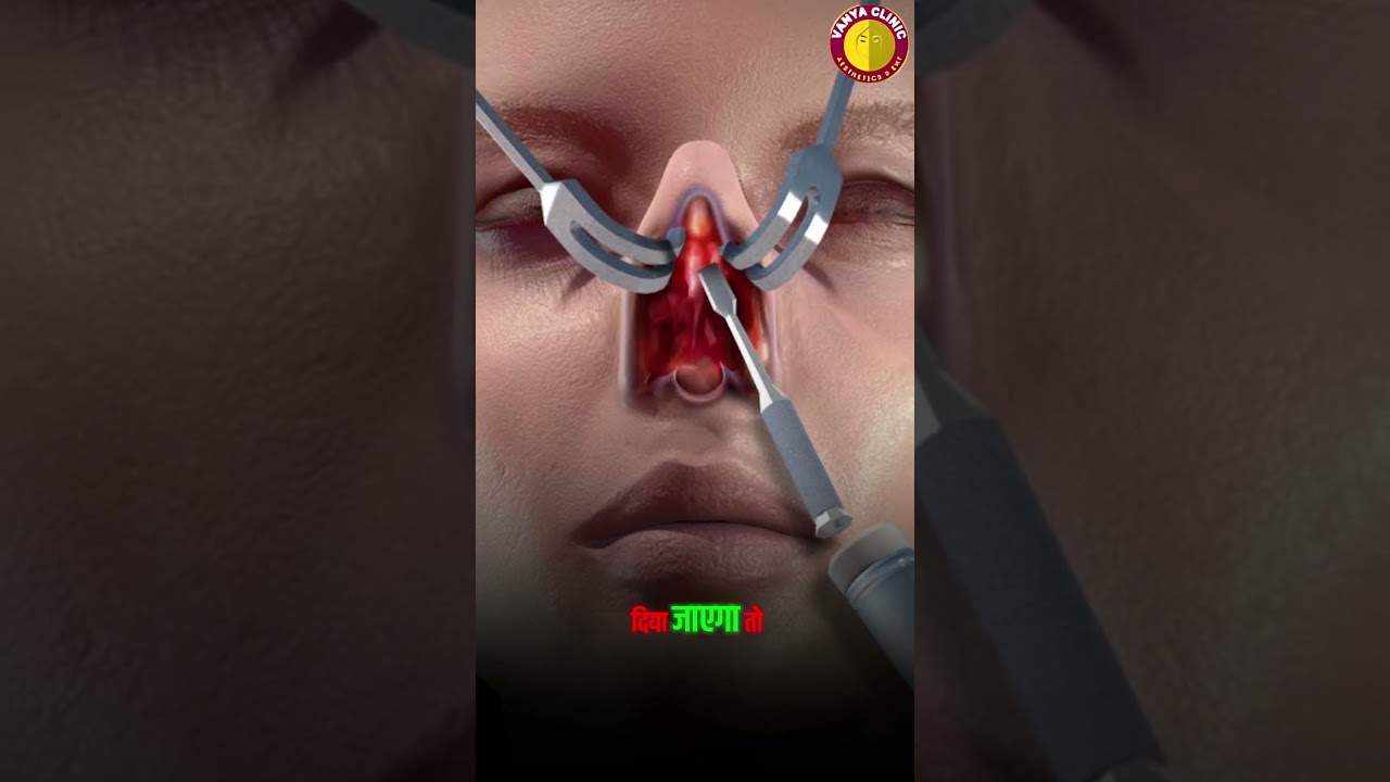 Tip swelling after rhinoplasty?? Know everything about it by Dr Anil Kumar Kaler. Contact 8448150908