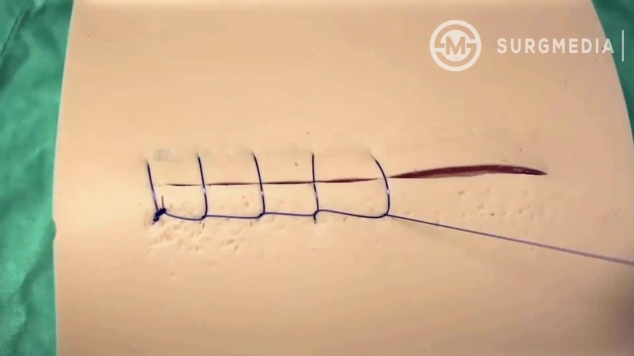 Ford Interlocking (Reverdin - Multanovski - Continuous Lock - Lock Stitch) Suture Pattern