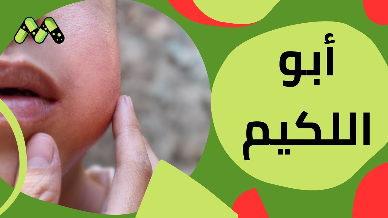 التهاب الغدة النكفية الفيروسية 