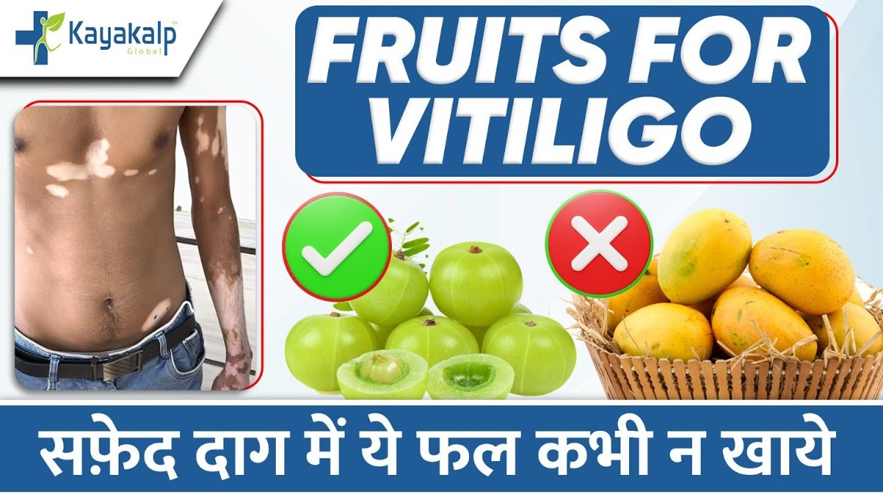 सफेद दाग के लिए फल: क्या खाएं क्या न खाएं? Fruits for Vitiligo Patient | Kayakalp Global